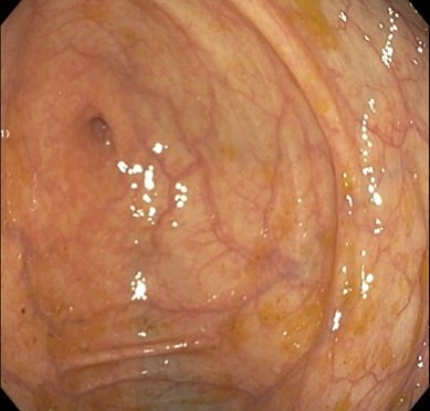 Colonoscopy frame of the cecum
